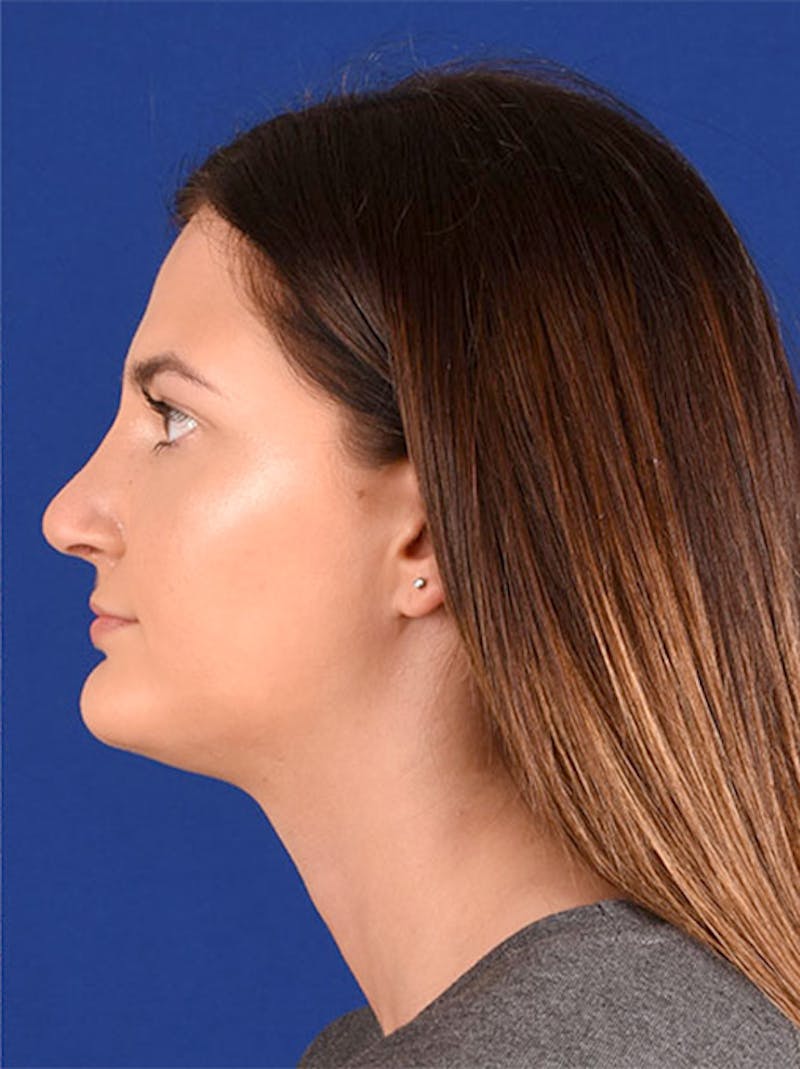Female Rhinoplasty Before & After Gallery - Patient 17363878 - Image 6