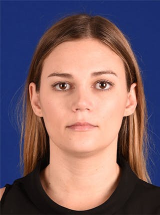 Female Rhinoplasty Before & After Gallery - Patient 17363882 - Image 2