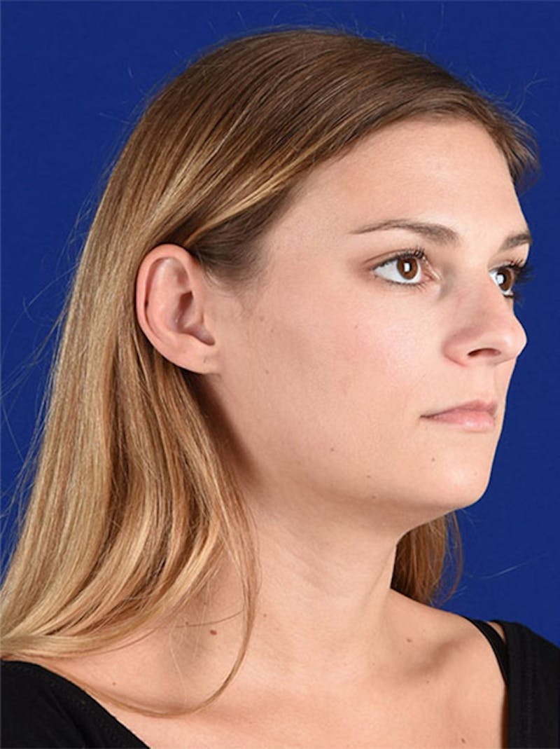 Female Rhinoplasty Before & After Gallery - Patient 17363882 - Image 3