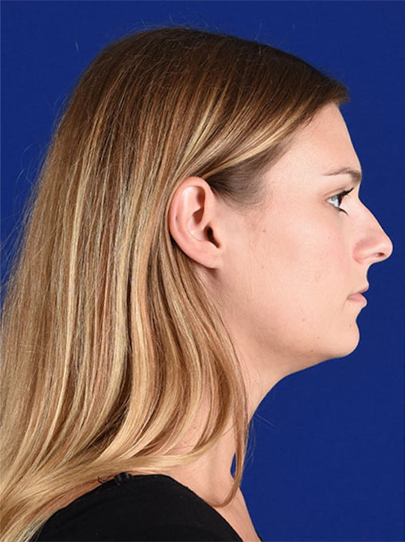 Female Rhinoplasty Before & After Gallery - Patient 17363882 - Image 5
