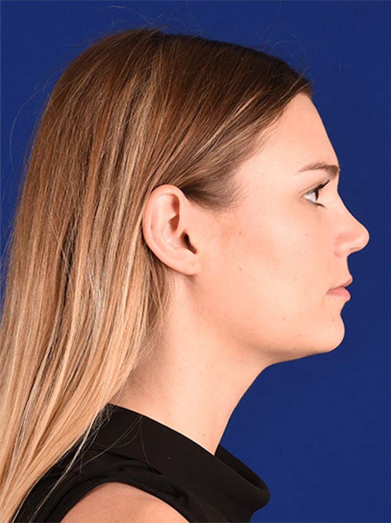 Female Rhinoplasty Before & After Gallery - Patient 17363882 - Image 6