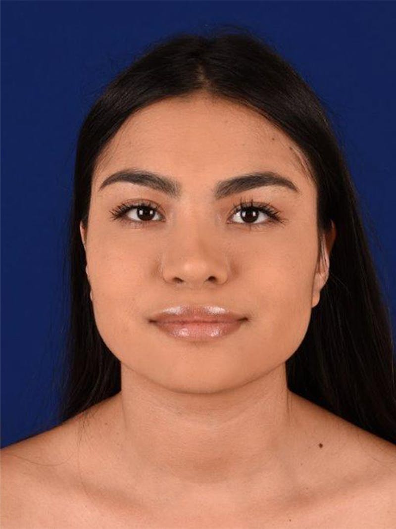 Female Rhinoplasty Before & After Gallery - Patient 17363885 - Image 2