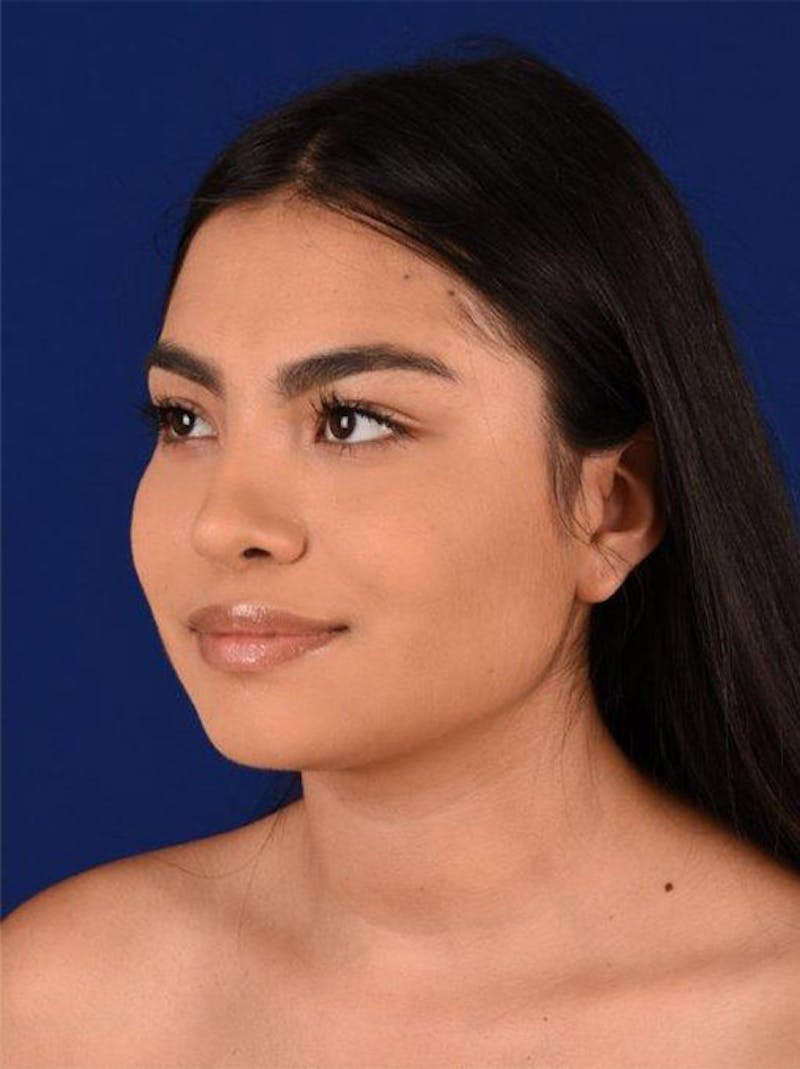 Female Rhinoplasty Before & After Gallery - Patient 17363885 - Image 4
