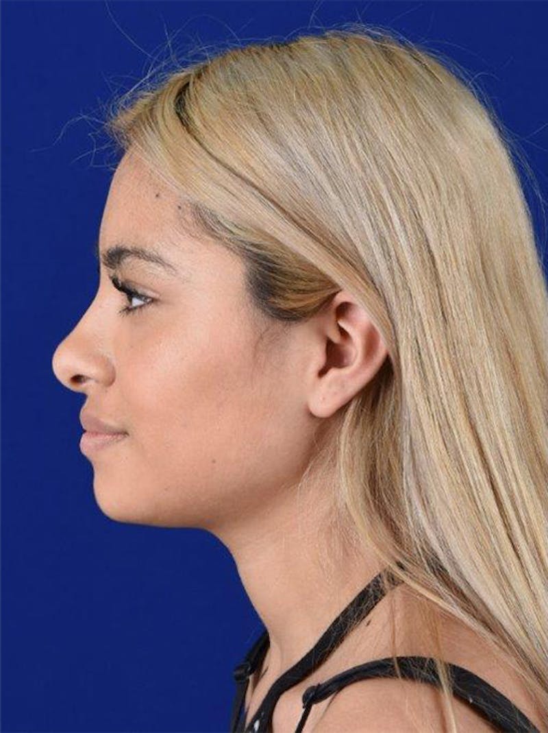Female Rhinoplasty Before & After Gallery - Patient 17363885 - Image 5