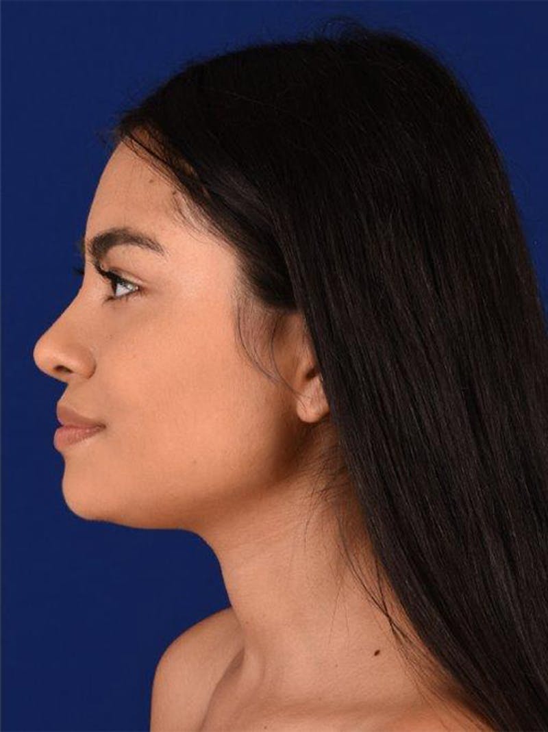 Female Rhinoplasty Before & After Gallery - Patient 17363885 - Image 6