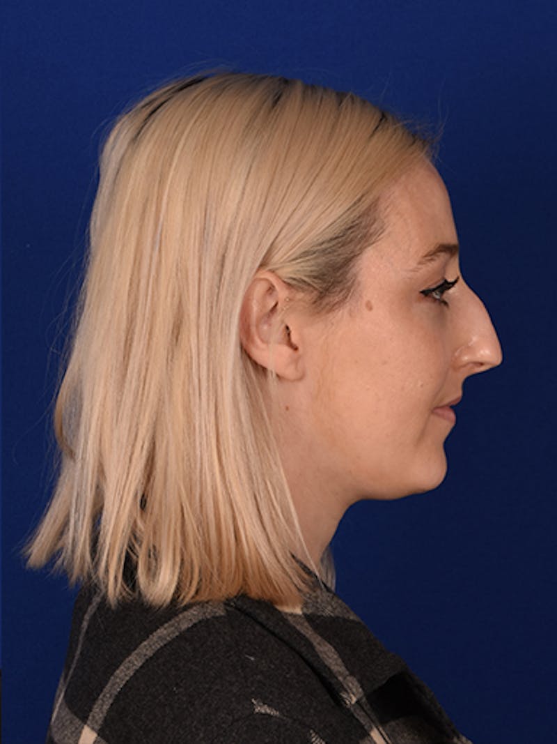 Female Rhinoplasty Before & After Gallery - Patient 17363886 - Image 5