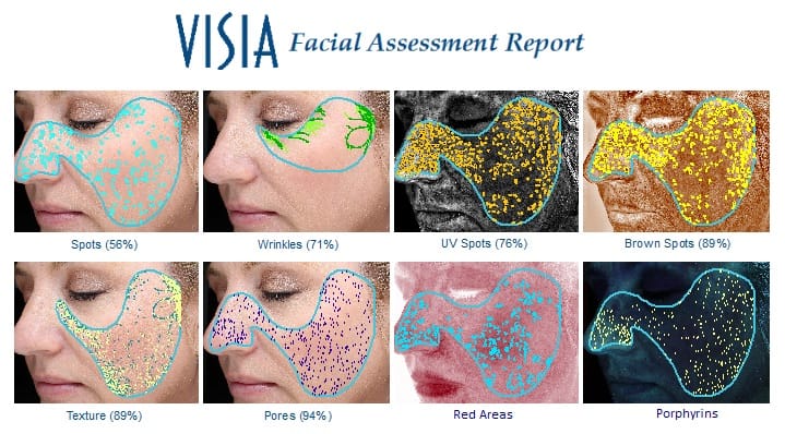 Visia Facial Assesment Report