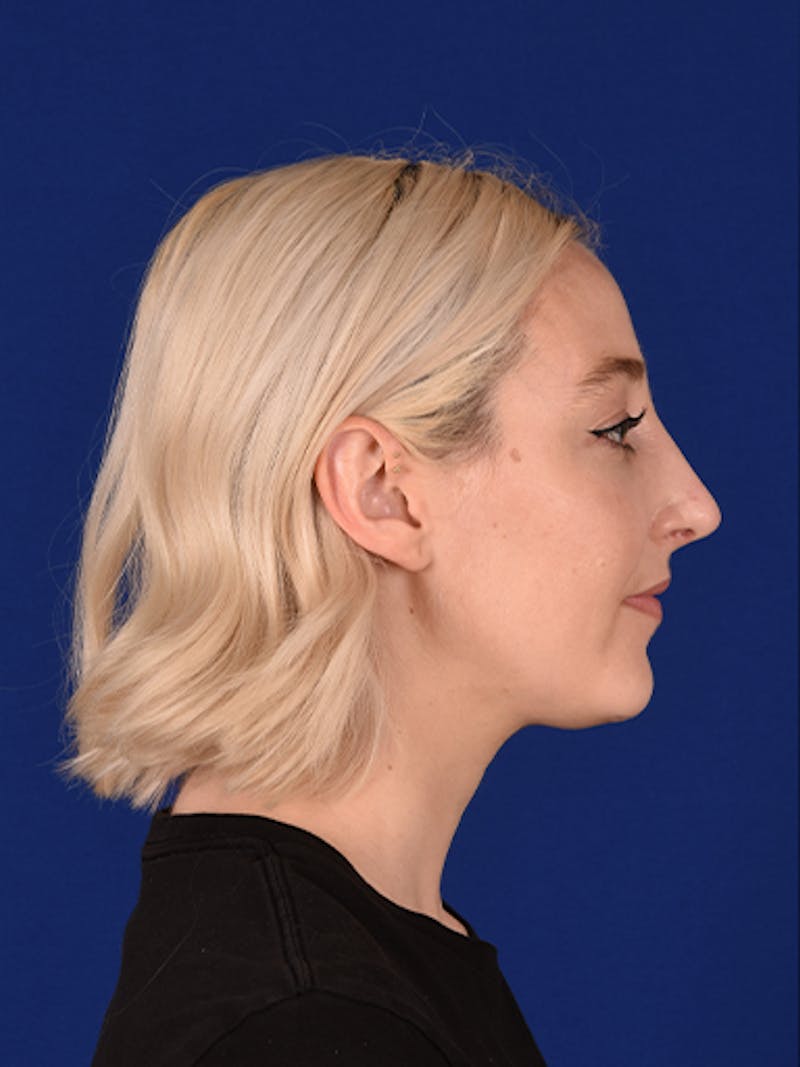 Female Rhinoplasty Before & After Gallery - Patient 17363886 - Image 6