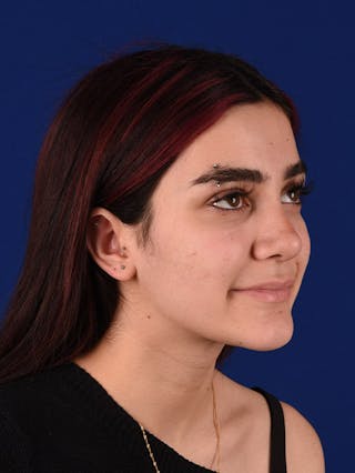 Female Rhinoplasty Before & After Gallery - Patient 17363891 - Image 4
