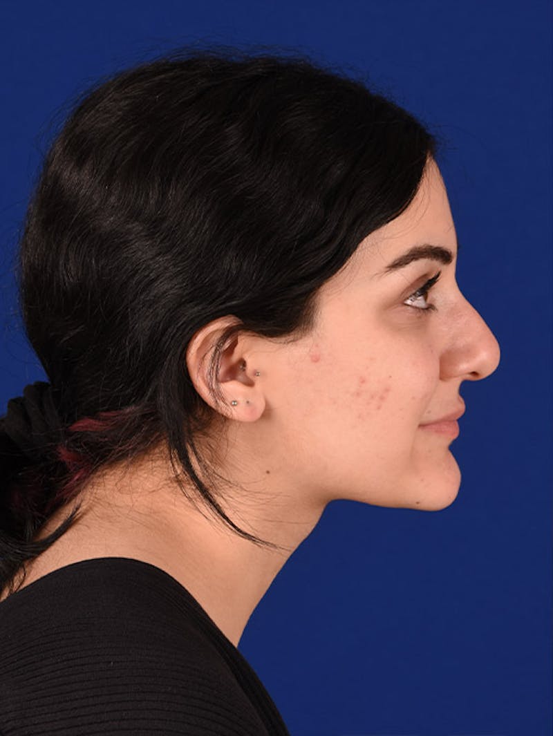 Female Rhinoplasty Before & After Gallery - Patient 17363891 - Image 5