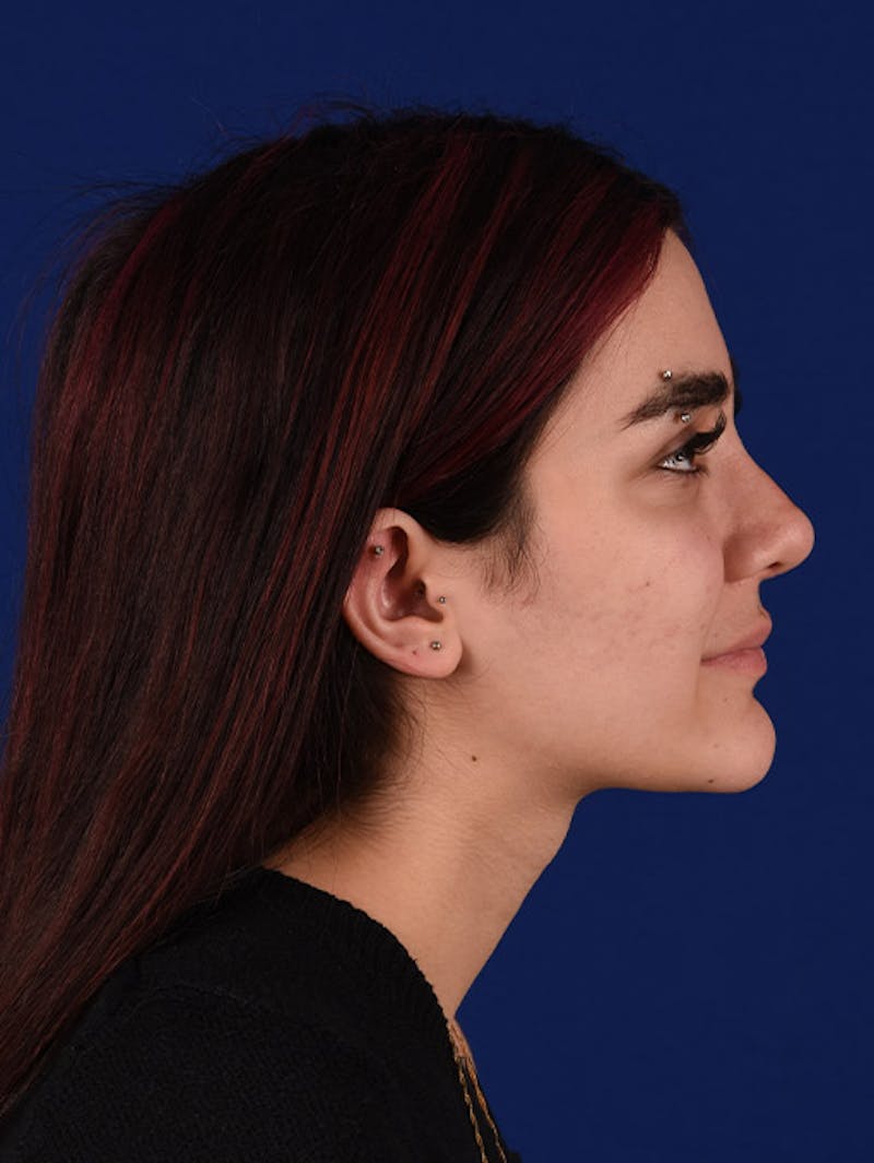 Female Rhinoplasty Before & After Gallery - Patient 17363891 - Image 6