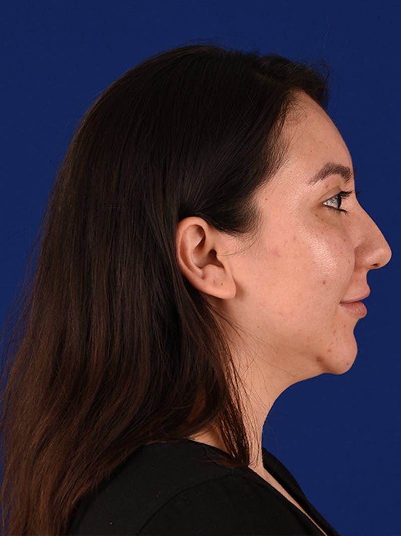 Female Rhinoplasty Before & After Gallery - Patient 17363895 - Image 5