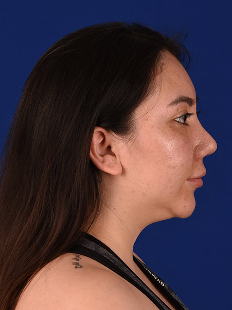Female Rhinoplasty Before & After Gallery - Patient 17363895 - Image 6