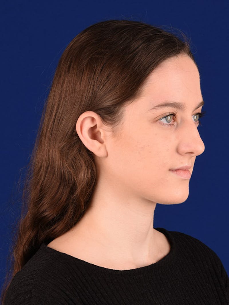 Female Rhinoplasty Before & After Gallery - Patient 17363899 - Image 3