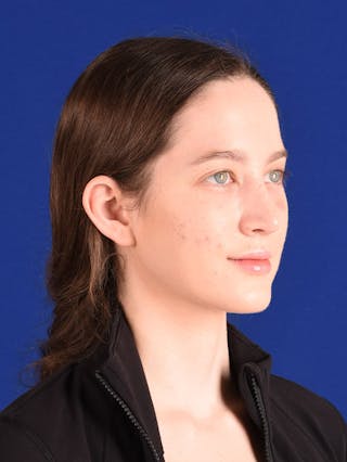 Female Rhinoplasty Before & After Gallery - Patient 17363899 - Image 4