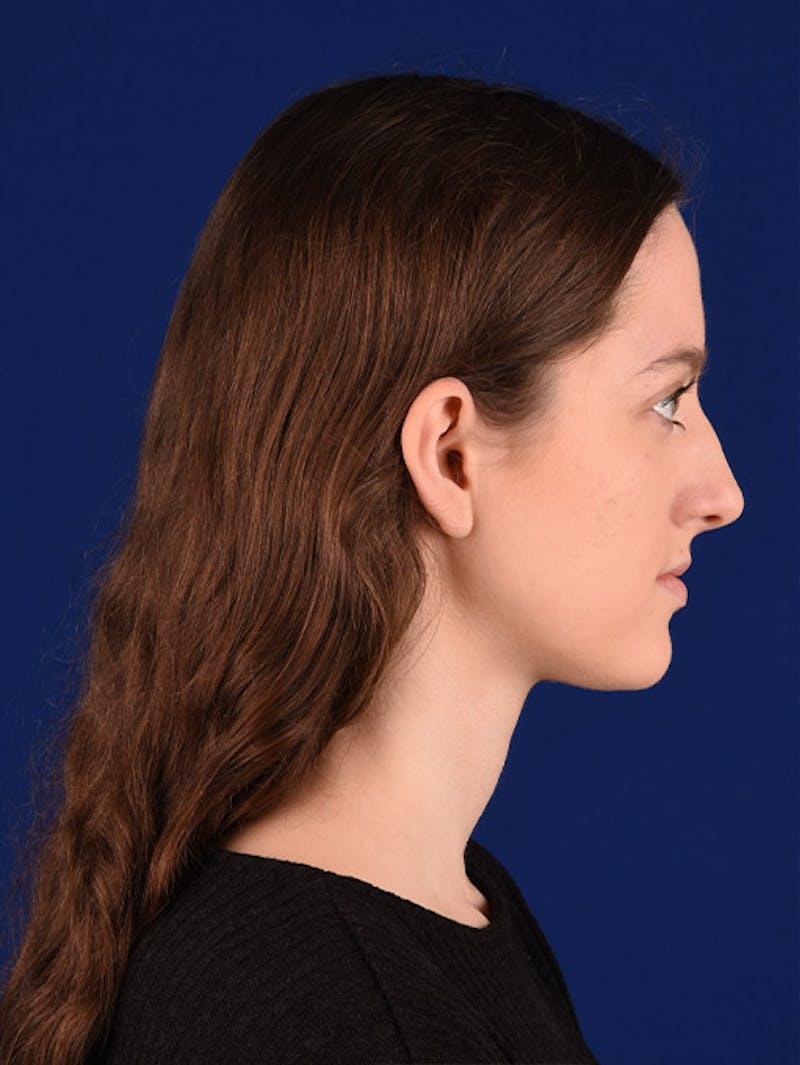 Female Rhinoplasty Before & After Gallery - Patient 17363899 - Image 5