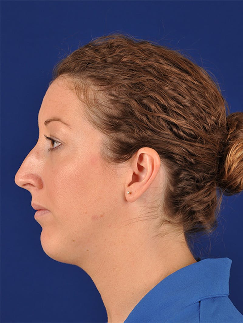 Female Rhinoplasty Before & After Gallery - Patient 17363909 - Image 5