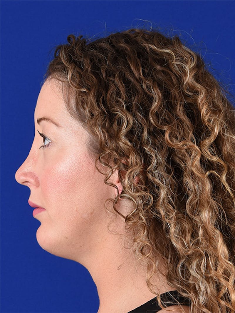 Female Rhinoplasty Before & After Gallery - Patient 17363909 - Image 6