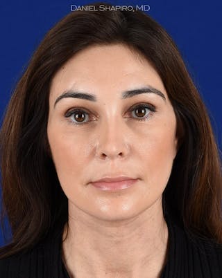 Female Rhinoplasty Before & After Gallery - Patient 17363913 - Image 2