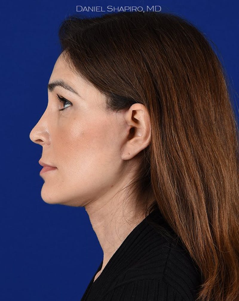 Female Rhinoplasty Before & After Gallery - Patient 17363913 - Image 6