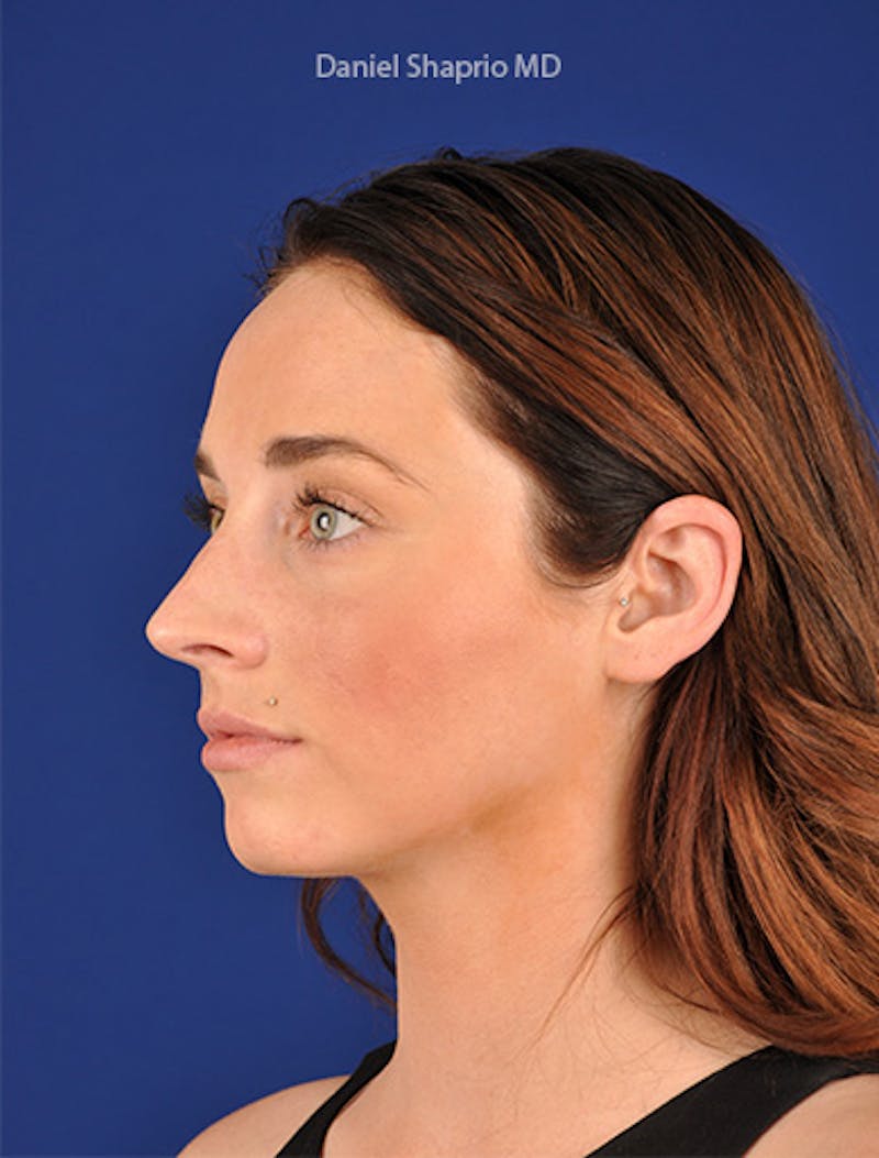 Female Rhinoplasty Before & After Gallery - Patient 17363917 - Image 3