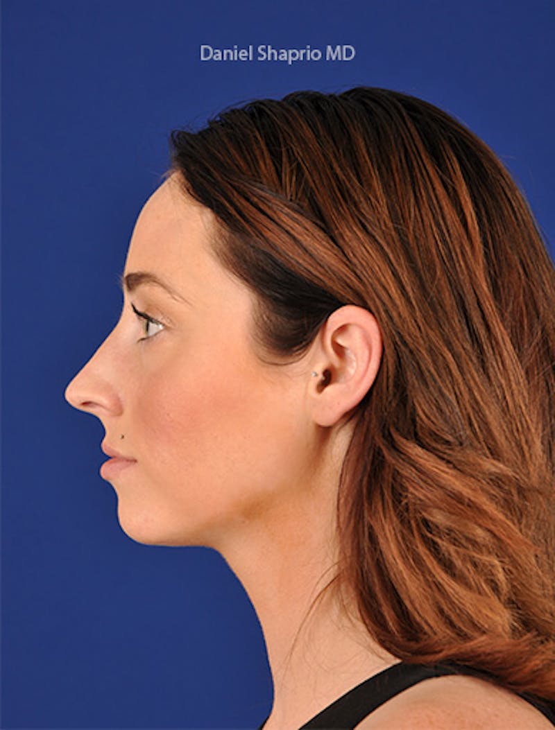 Female Rhinoplasty Before & After Gallery - Patient 17363917 - Image 5