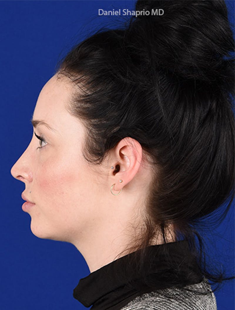 Female Rhinoplasty Before & After Gallery - Patient 17363917 - Image 6