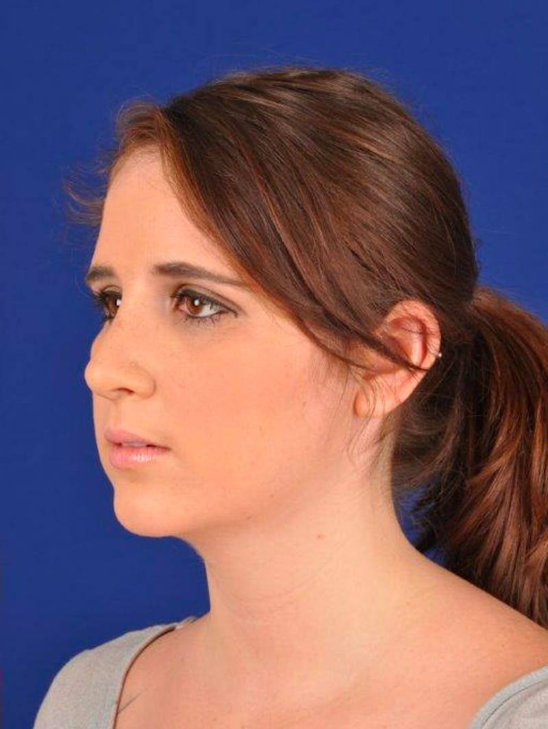 Female Rhinoplasty Before & After Gallery - Patient 17363918 - Image 4