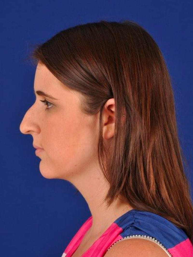Female Rhinoplasty Before & After Gallery - Patient 17363918 - Image 5