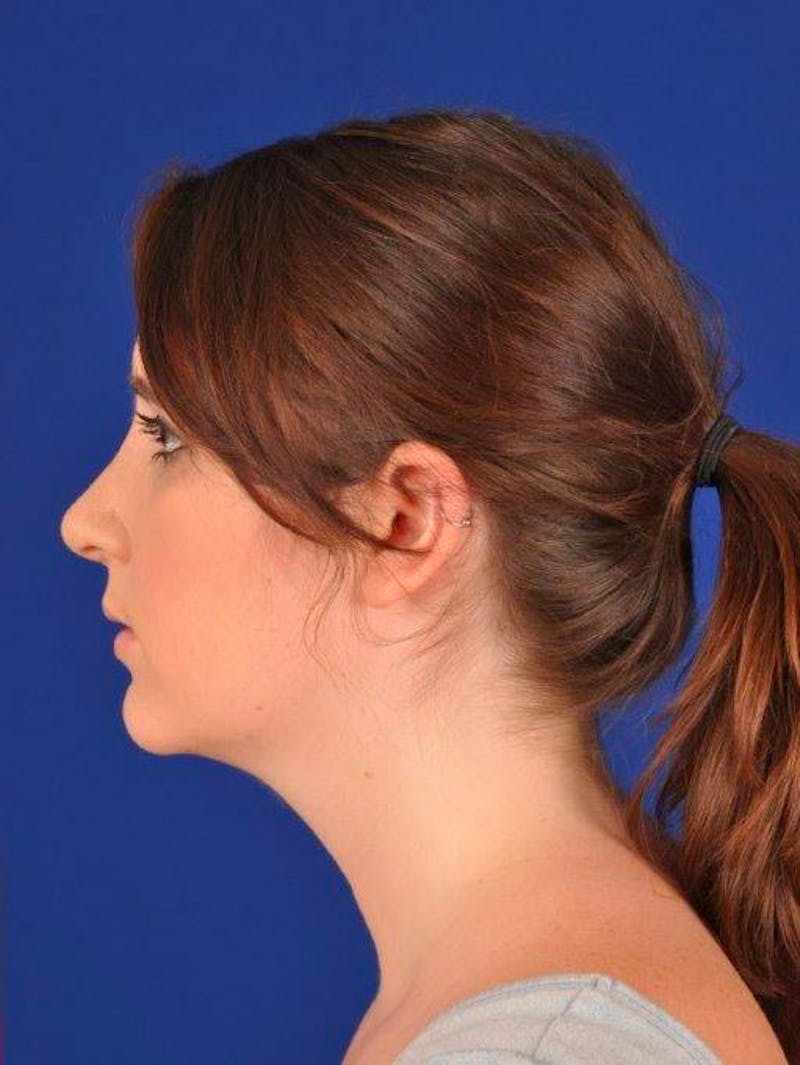 Female Rhinoplasty Before & After Gallery - Patient 17363918 - Image 6