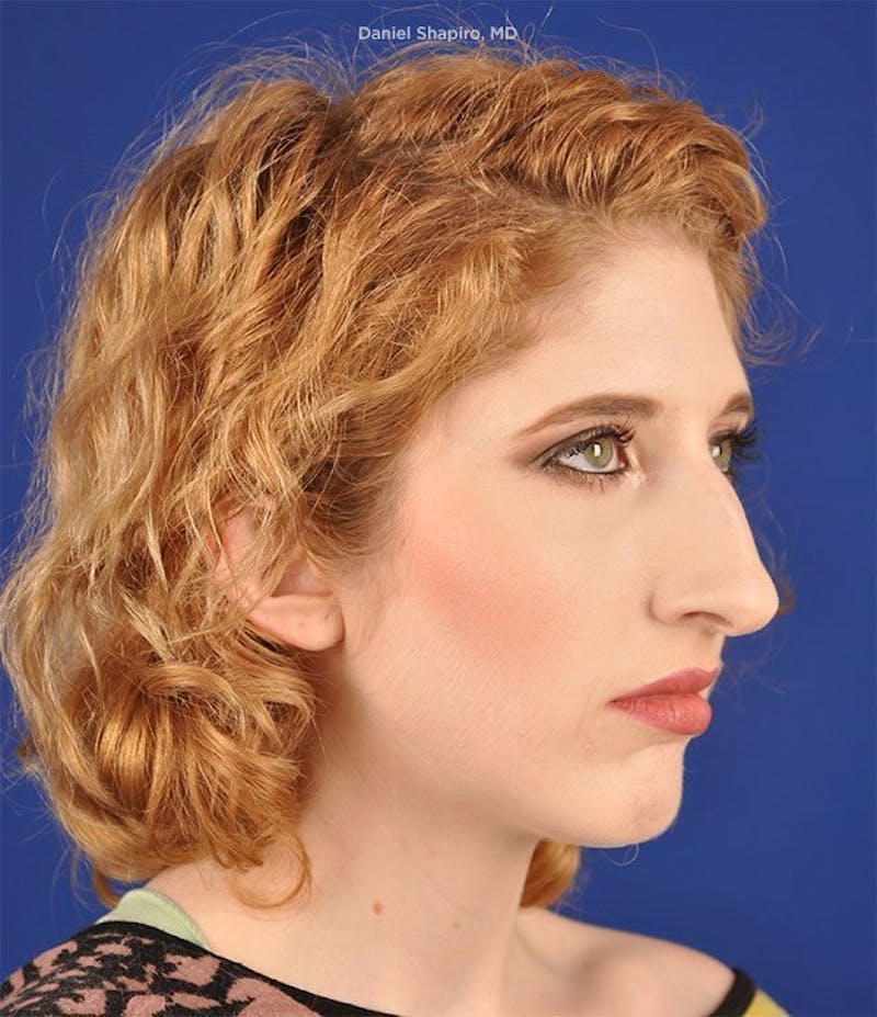 Female Rhinoplasty Before & After Gallery - Patient 17363920 - Image 3