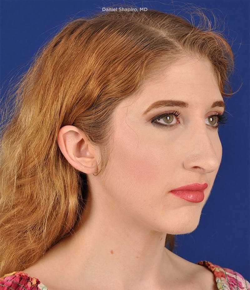 Female Rhinoplasty Before & After Gallery - Patient 17363920 - Image 4