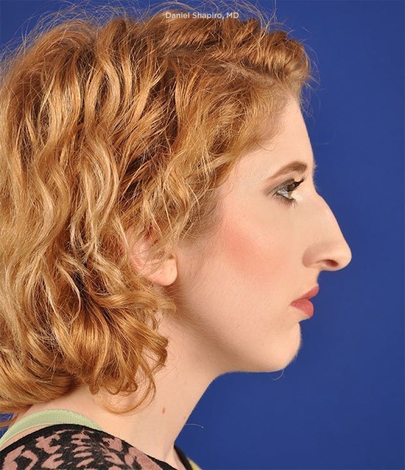 Female Rhinoplasty Before & After Gallery - Patient 17363920 - Image 5