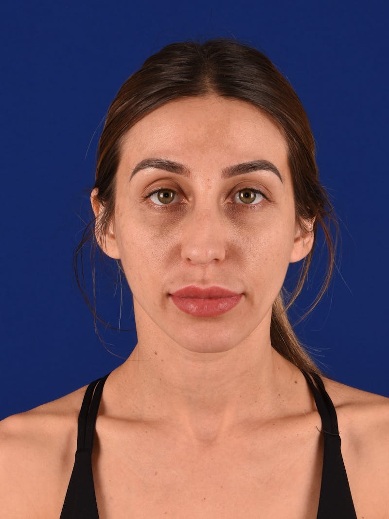 Female Rhinoplasty Before & After Gallery - Patient 17363924 - Image 1