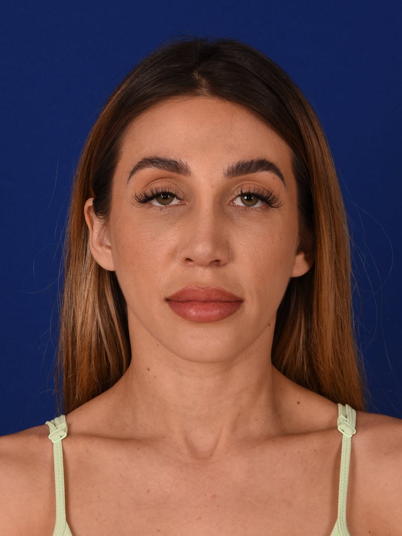 Female Rhinoplasty Before & After Gallery - Patient 17363924 - Image 2