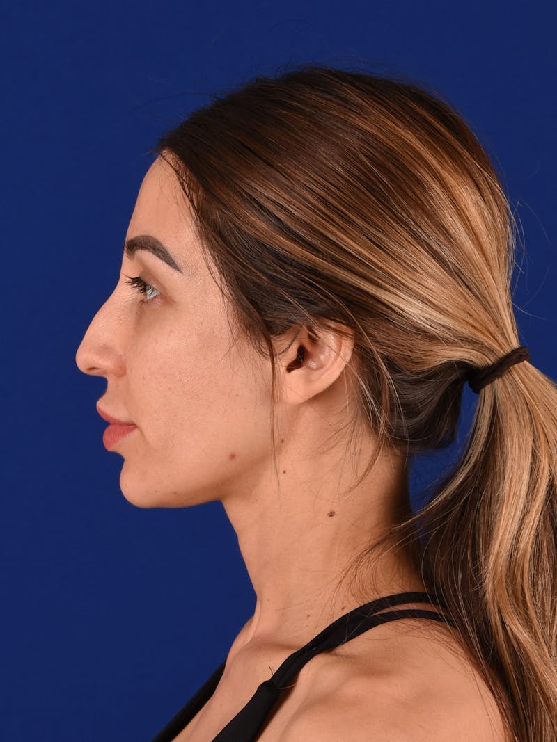 Female Rhinoplasty Before & After Gallery - Patient 17363924 - Image 5