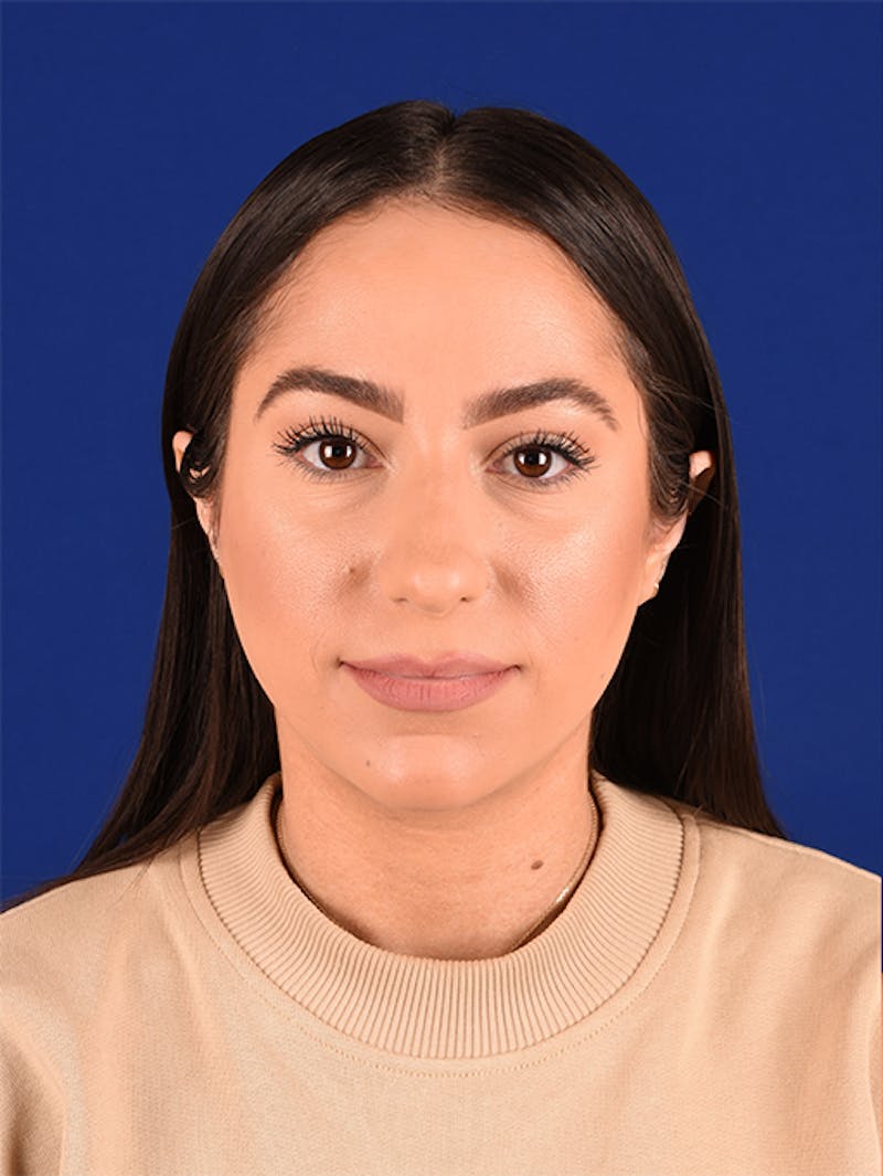 Female Rhinoplasty Before & After Gallery - Patient 17363928 - Image 1