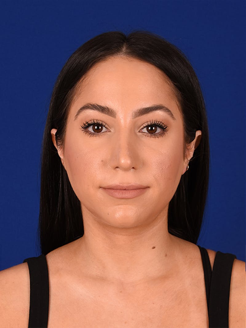 Female Rhinoplasty Before & After Gallery - Patient 17363928 - Image 2