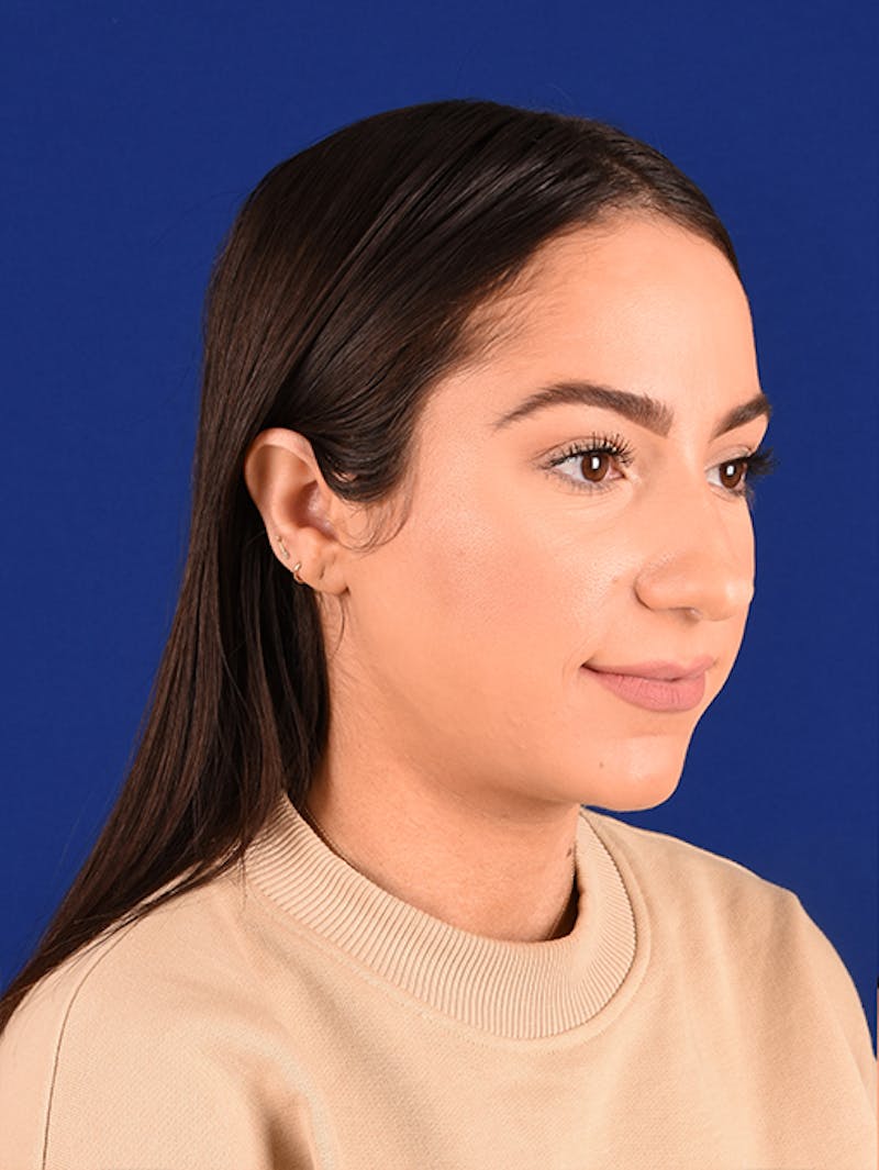 Female Rhinoplasty Before & After Gallery - Patient 17363928 - Image 3