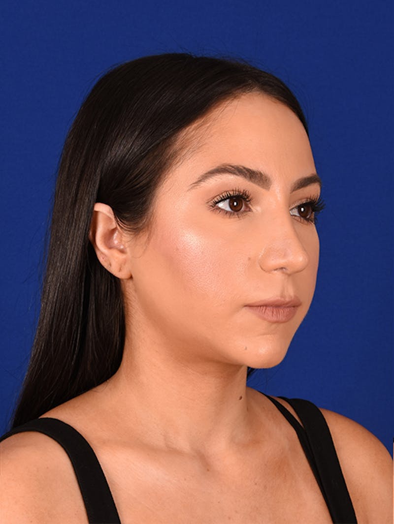 Female Rhinoplasty Before & After Gallery - Patient 17363928 - Image 4