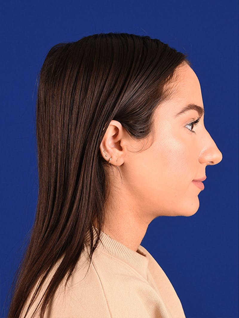 Female Rhinoplasty Before & After Gallery - Patient 17363928 - Image 5