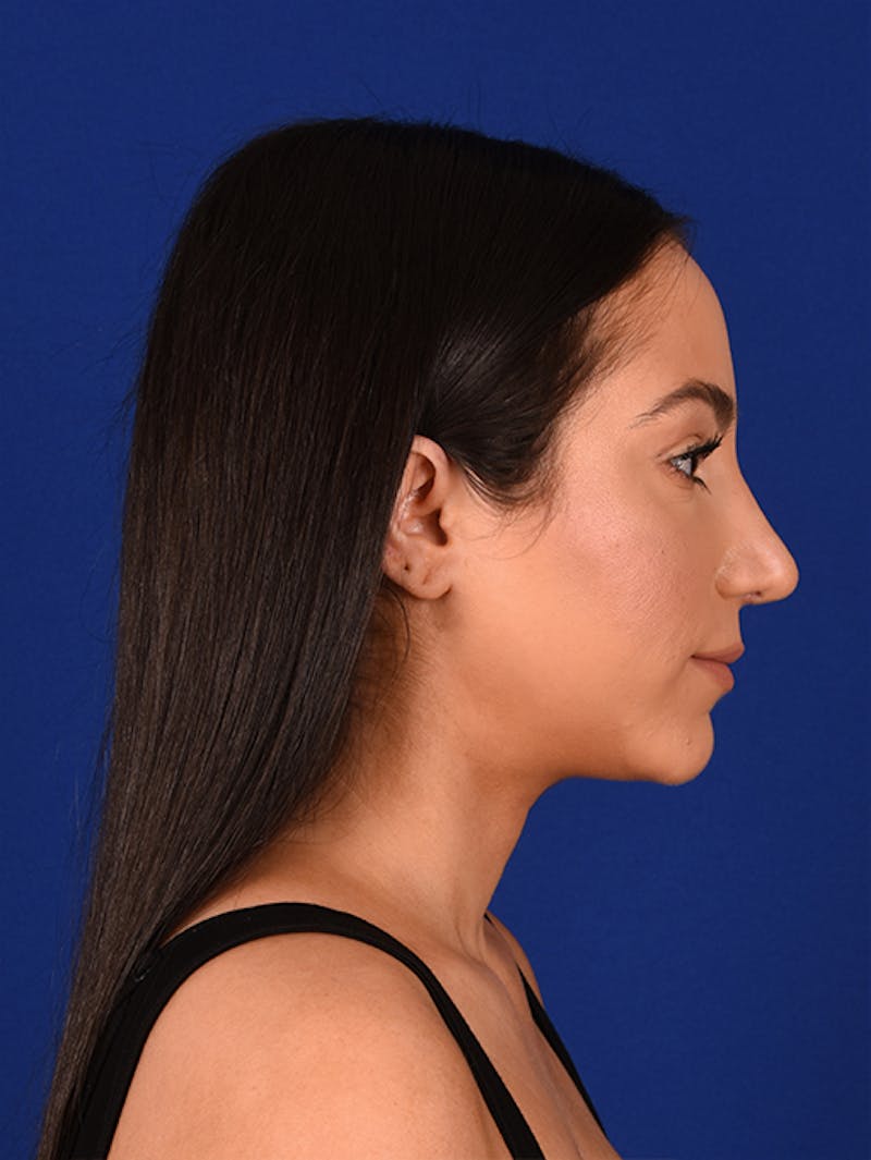 Female Rhinoplasty Before & After Gallery - Patient 17363928 - Image 6