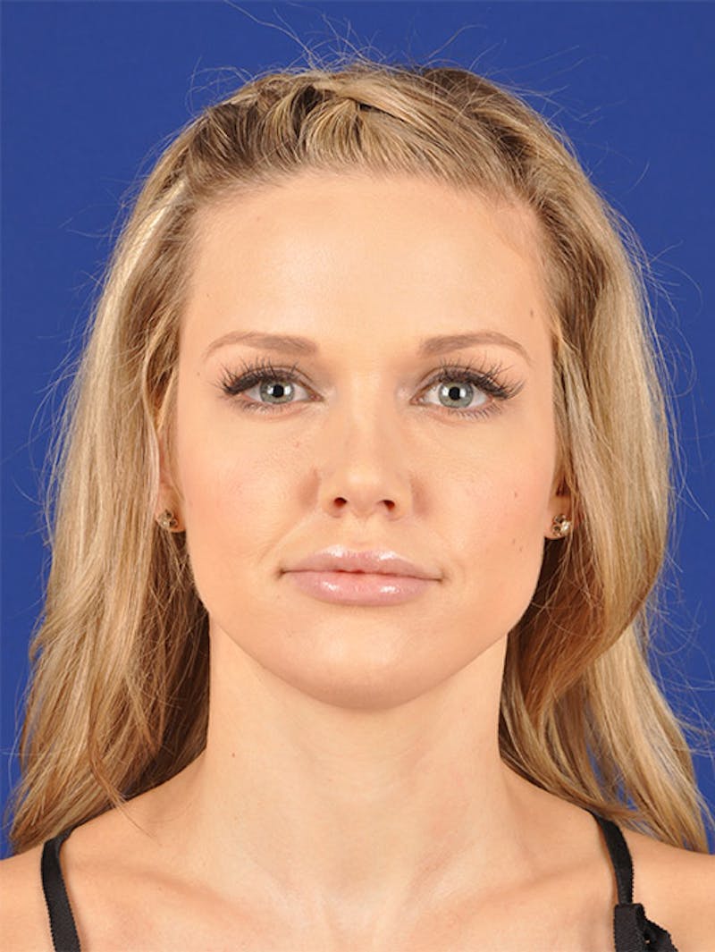Female Rhinoplasty Before & After Gallery - Patient 17363929 - Image 2