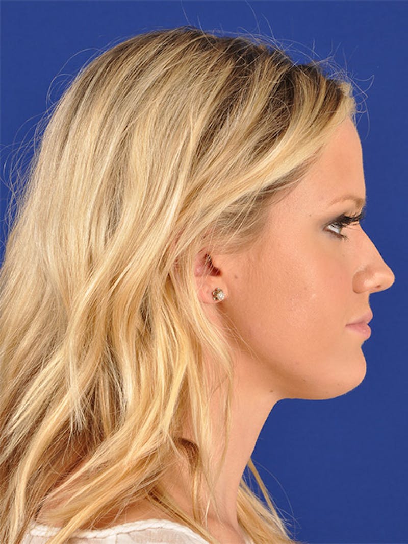 Female Rhinoplasty Before & After Gallery - Patient 17363929 - Image 5