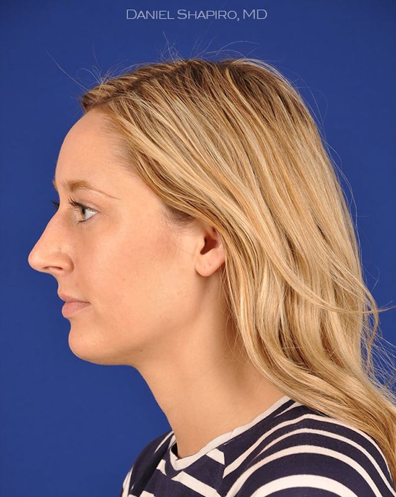 Female Rhinoplasty Before & After Gallery - Patient 17363930 - Image 5