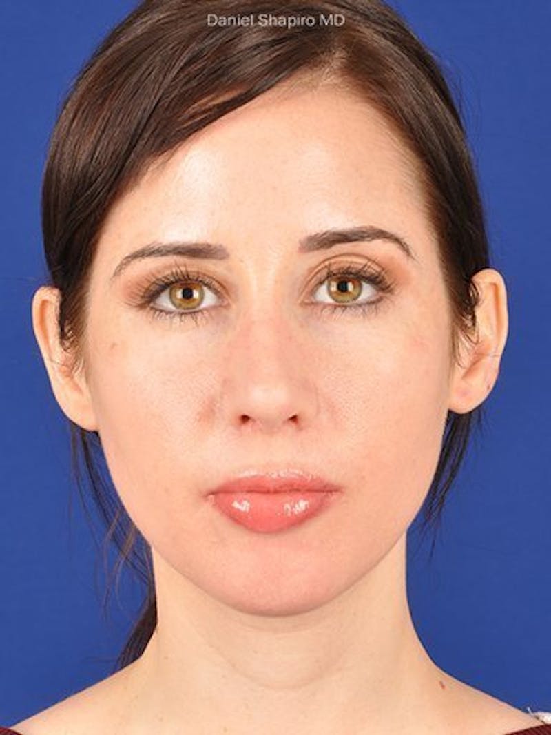 Female Rhinoplasty Before & After Gallery - Patient 17363932 - Image 2