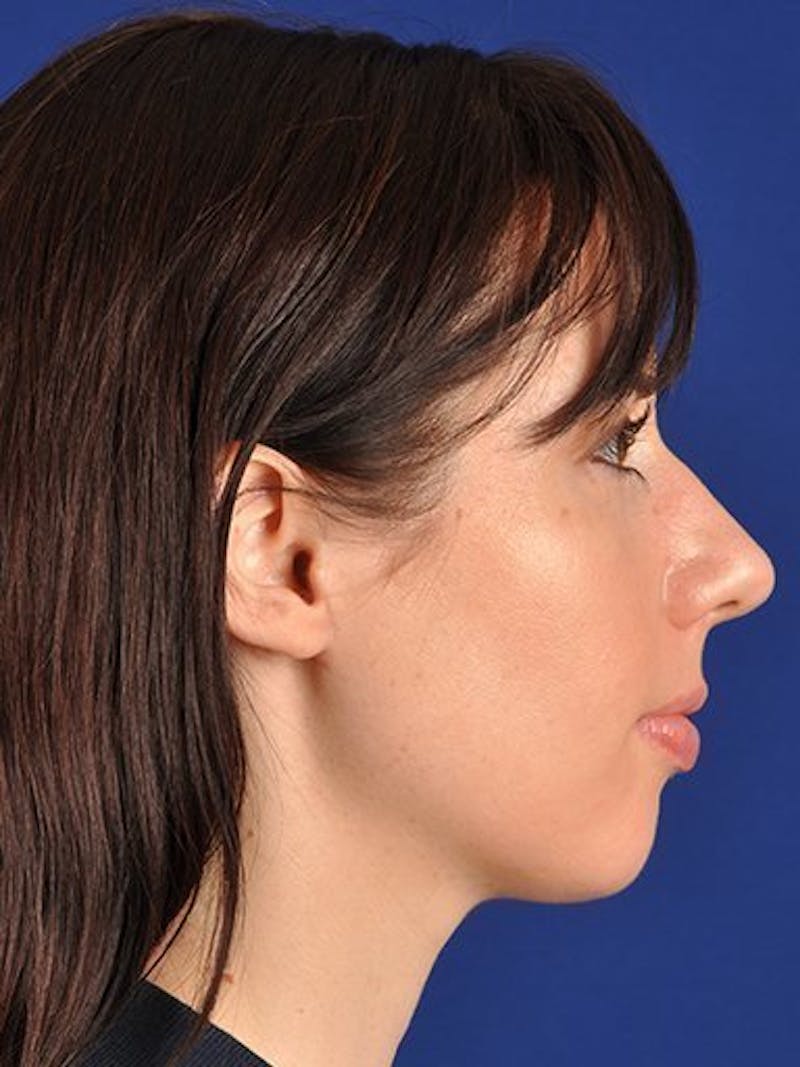 Female Rhinoplasty Before & After Gallery - Patient 17363932 - Image 5