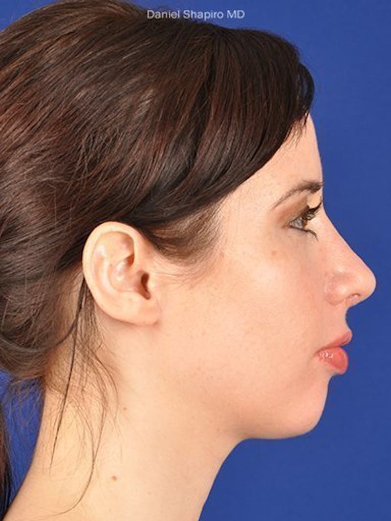 Female Rhinoplasty Before & After Gallery - Patient 17363932 - Image 6