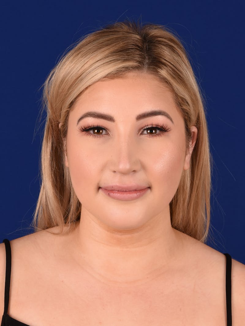 Female Rhinoplasty Before & After Gallery - Patient 17363940 - Image 2