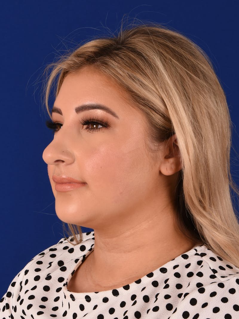 Female Rhinoplasty Before & After Gallery - Patient 17363940 - Image 3